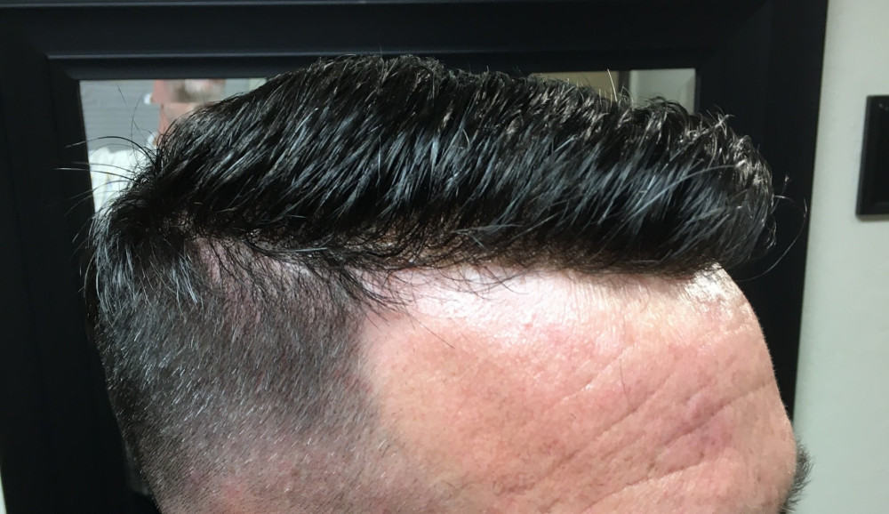 Non Surgical Hair Replacement Before And After Photos