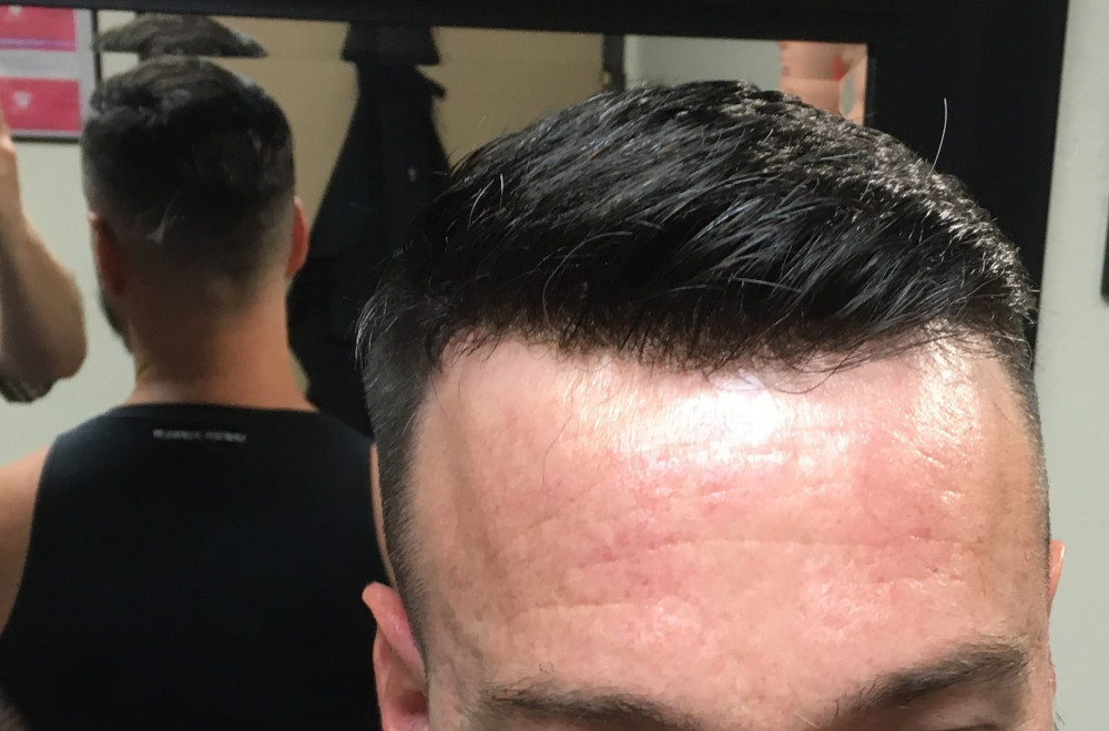Non Surgical Hair Replacement Before And After Photos