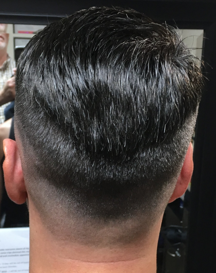 Non Surgical Hair Replacement Before And After Photos