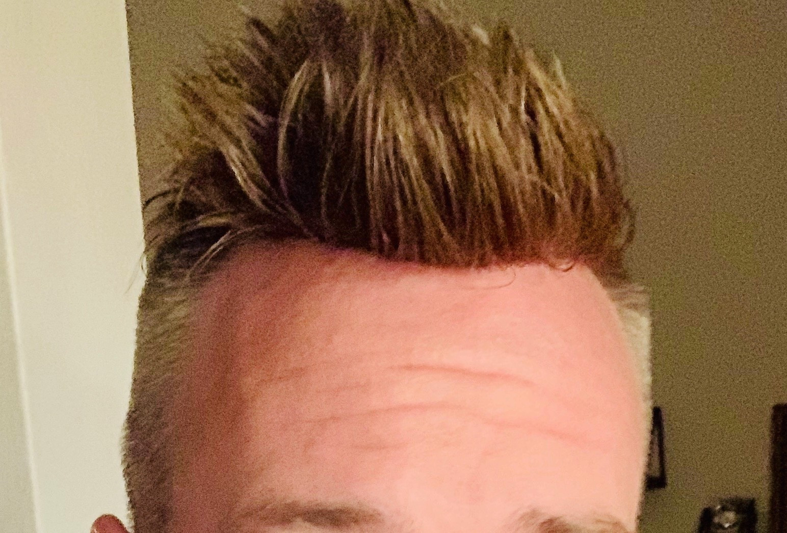 Non Surgical Hair Replacement Before And After Photos
