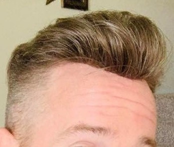 Non Surgical Hair Replacement Before And After Photos