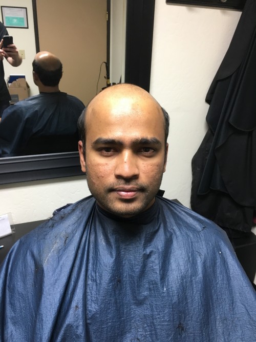 Non Surgical Hair Replacement Before And After Photos