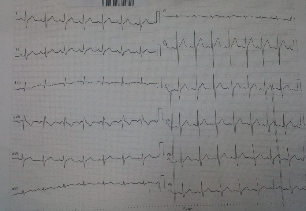 ECG Pulmonary Embolism