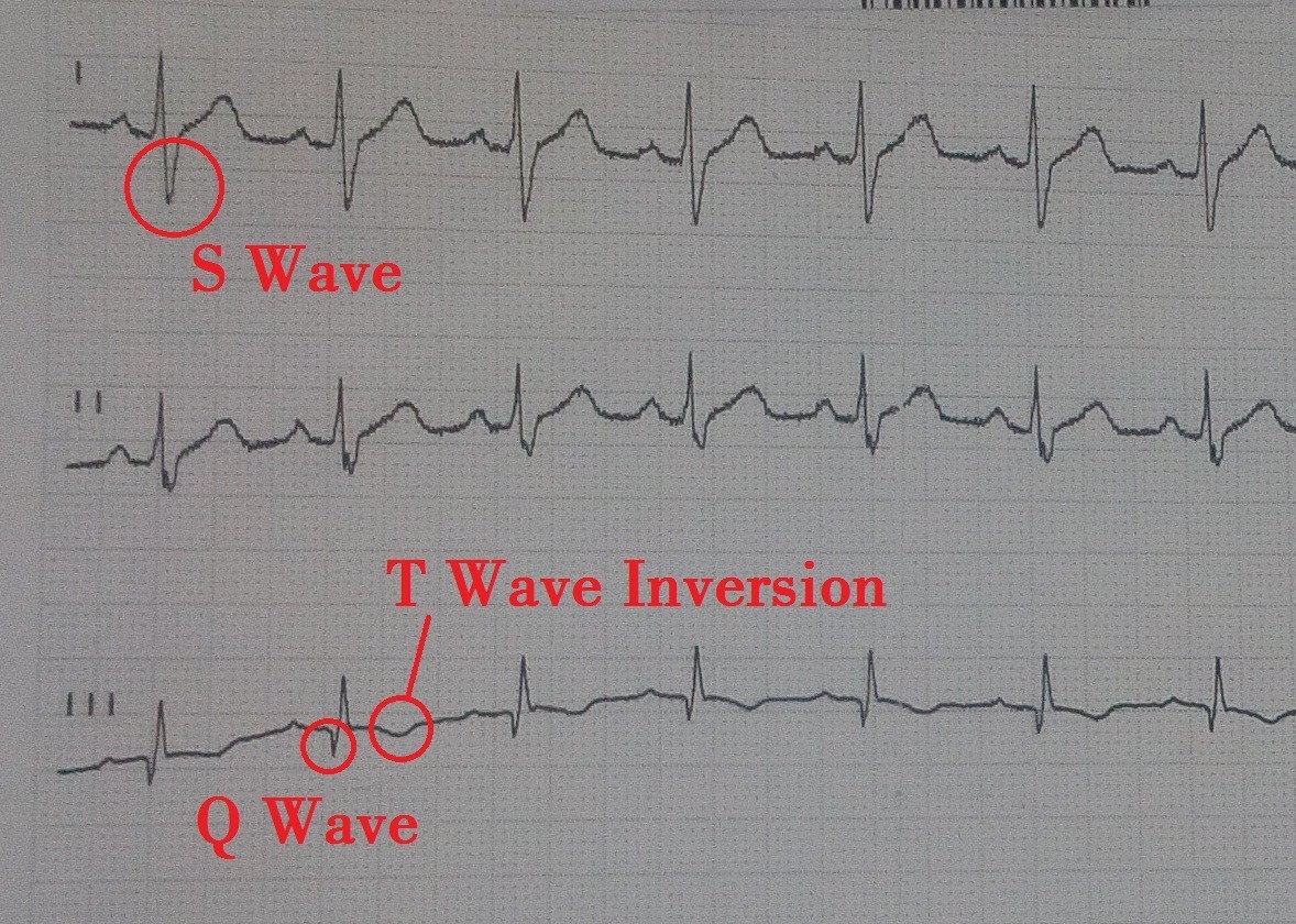 s1q3t3 pattern on ECG for pulmonary embolism