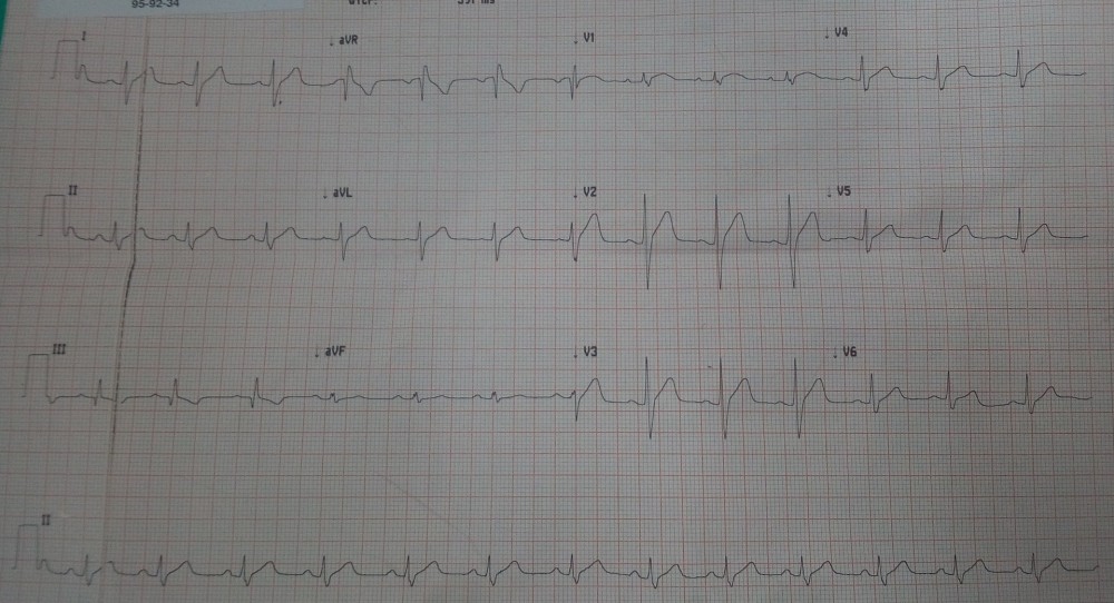 ECG Pulmonary Embolism