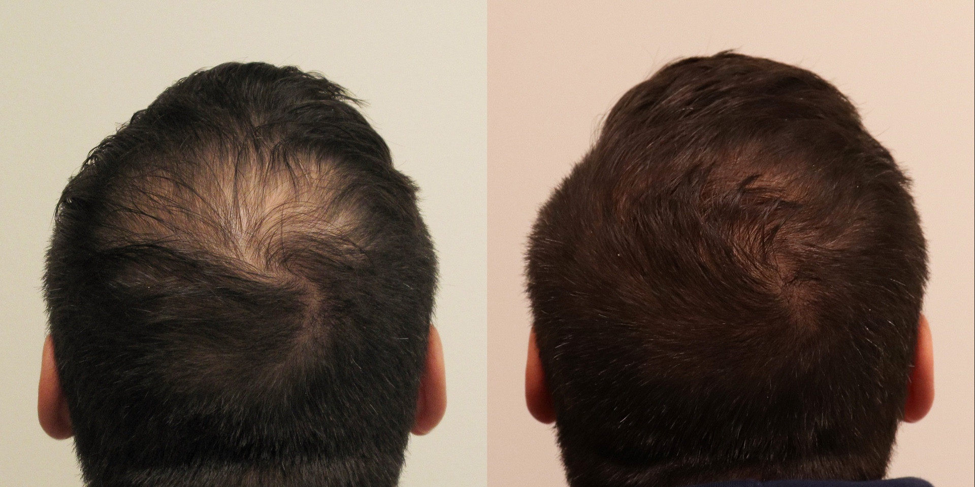 Nonsurgical Hair Restoration