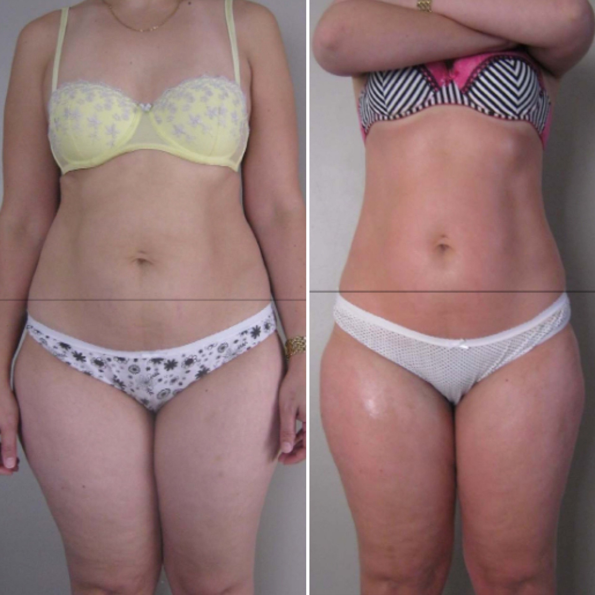 Cellulite Treatment Long Beach Ca Cellulite Treatment Long Beach Ca