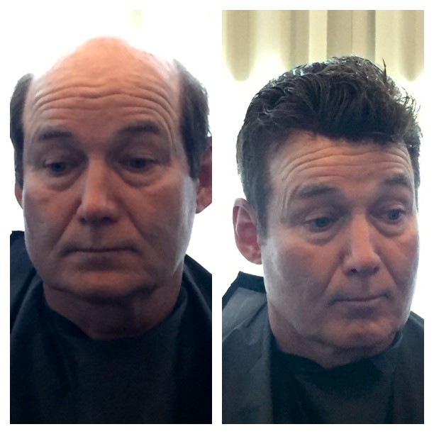 Affordable Help With Hair Replacement Hair Extensions Passionate
