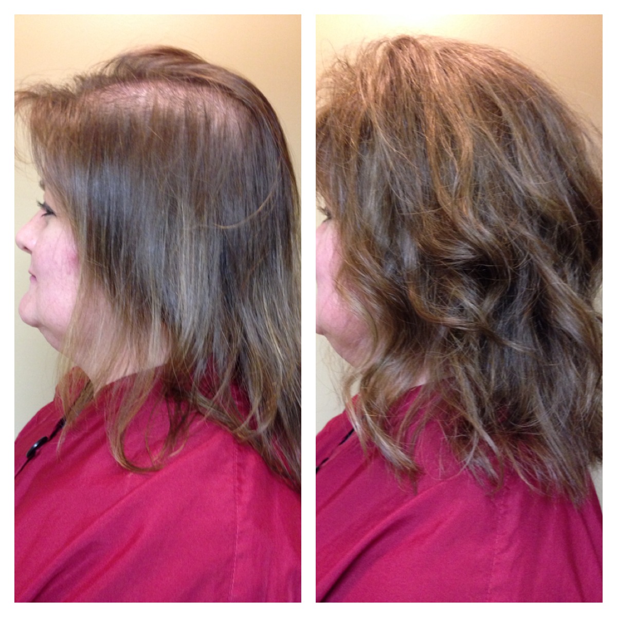 Passionate About Helping With Hair Loss Hair Replacement Thin