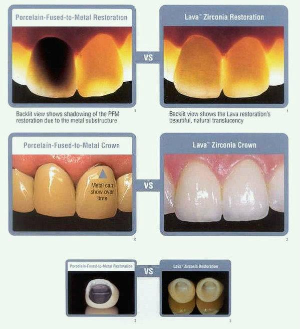 Riverside Dental Crowns